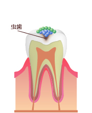 お子さまを虫歯から守るために大切なこと