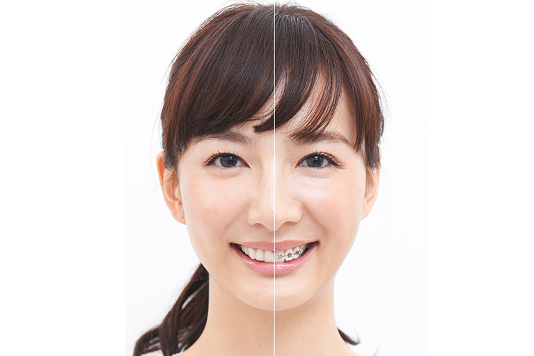 目立たないマウスピース矯正装置