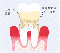 歯周病検査の重要性
