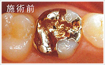 cerec