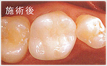 cerec