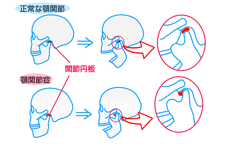 正常な噛み合わせを作ることによる顎関節症の治療