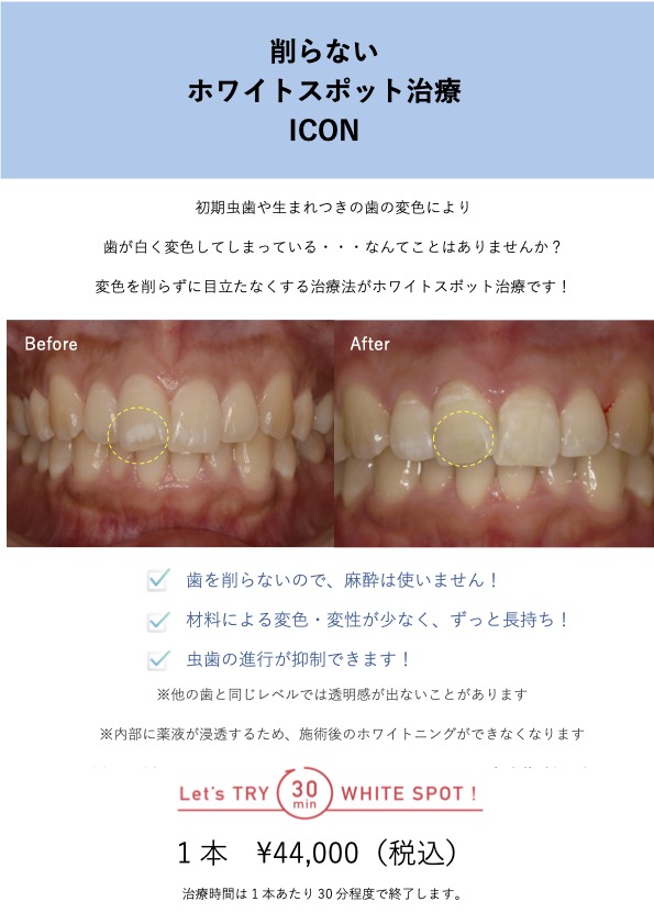 ホワイトスポット治療